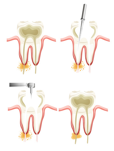 Root Canals